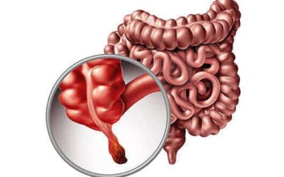 Is Appendix Cancer Different From Colon Cancer?
