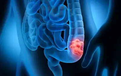 Is Appendix Cancer Treated Like Colon Cancer?