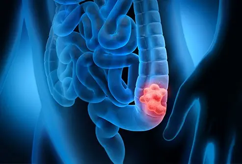 Appendix Cancer vs Colon Cancer Treatment - Dr. Sandeep Nayak