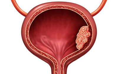 Is Bladder Preservation Possible in Bladder Cancer?