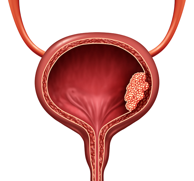 Is bladder preservation possible in bladder cancer Dr. Sandeep Nayak