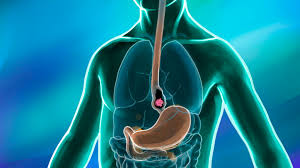 Is Esophageal Cancer Operable After Chemo?