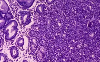 Is a Neuroendocrine Tumour a Cancer?