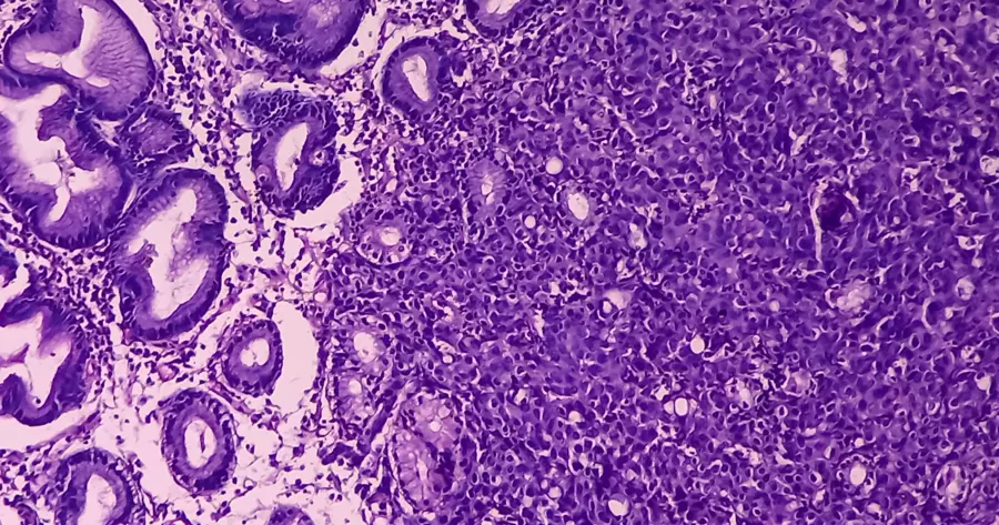 Is a Neuroendocrine Tumour a Cancer - Dr. Sandeep Nayak