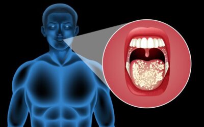 Neck Dissection: When Is It Done With Oral Cancer Surgery?