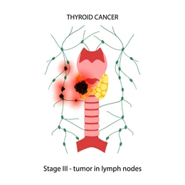Picture Diagram of the thyroid with cancer spreading to surrounding lymph nodes (Stage III).