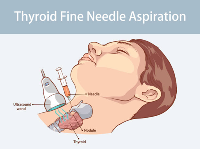 Picture Illustration of ultrasound-guided thyroid fine-needle aspiration showing a needle sampling a thyroid nodule in the neck.