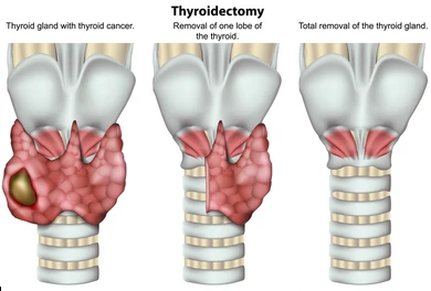 Picture Illustration of ultrasound-guided thyroid fine-needle aspiration showing a needle sampling a thyroid nodule in the neck.