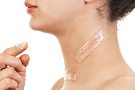 Picture Close-up of a person applying adhesive bandages to the neck with two Band-Aids already in place.