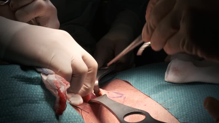 Picture | Dr Sandeep Nayak close-up of surgeons' gloved hands using a scalpel during an operation on a patient.