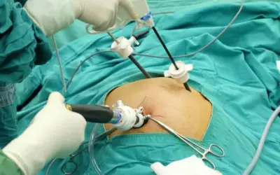 Robotic Surgery for Bile Duct Cancer?