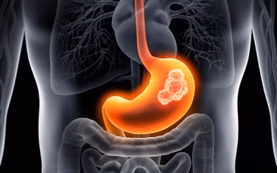 Stomach Cancer vs GIST: Is Treatment the Same?