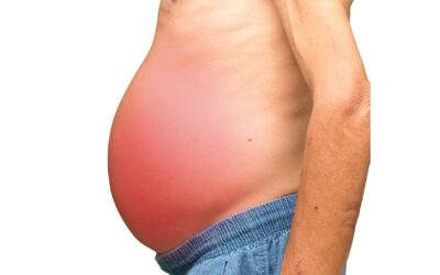 What Is Ascites and When Does It Happen in Cancer?