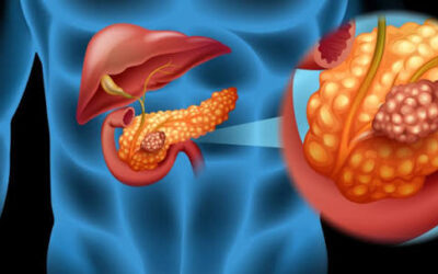 What Is Familial Pancreatic Cancer?