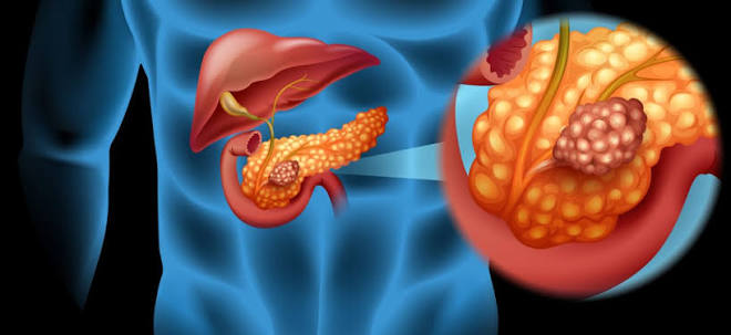 What Is Familial Pancreatic Cancer - Dr. Sandeep Nayak