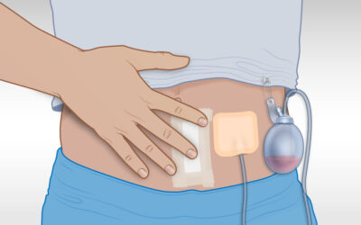 What Is a Drain After Surgery and When Is It Removed?