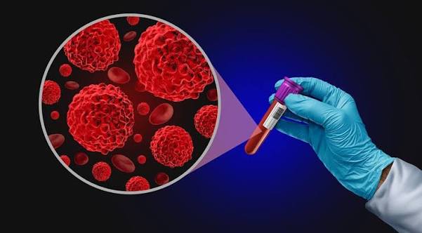What Is a Liquid Biopsy in Cancer - Dr. Sandeep Nayak