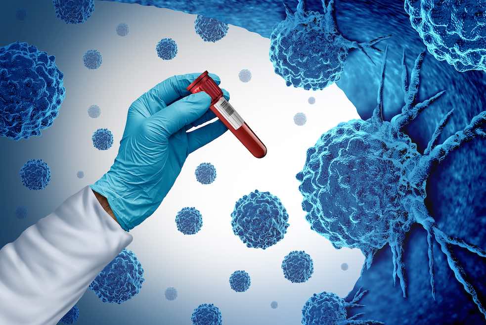 Multi-Cancer Early Detection Test - Dr. Sandeep Nayak