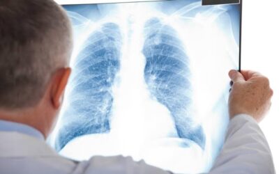 Can Lung Cancer Be Detected on a Chest X-Ray?