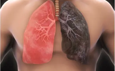 Can Non-Smokers Get Lung Cancer?