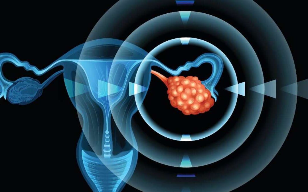 Can Ovarian Cancer Be Caught Early - Dr. Sandeep Nayak