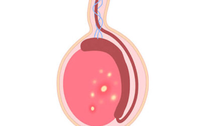 Cost of Testicular Cancer Surgery in India?