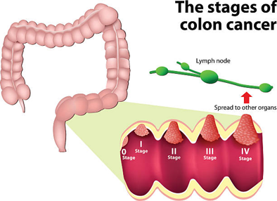 Picture Diagram of the colon showing cancer progression from Stage 0 to Stage IV with a cutaway view and a lymph node indicating spread.