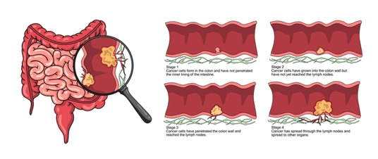 Picture Diagram of colon cancer progression with a magnified view of a tumor and four stages showing tumor growth through the colon wall.