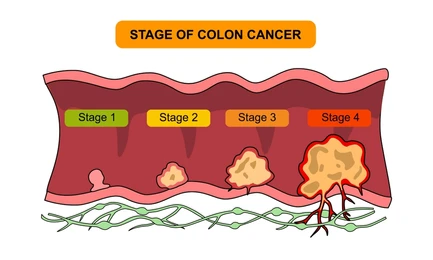 Picture Cross-sectional illustration of the colon showing cancer progression from Stage 1 to Stage 4, with labeled stages and a large tumor at Stage 4.
