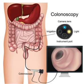 Picture Medical illustration of a colonoscopy: a colonoscope is inserted through the rectum into the colon, connected to a monitor showing the intestinal interior; labelled camera lens, light, irrigation, and instrument port.