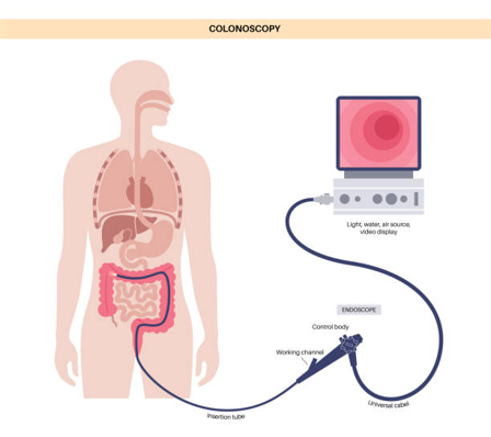 Illustration of colonoscopy: a flexible endoscope inserted through the rectum into the colon, with a monitor showing the internal view.