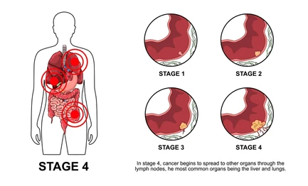 Picture Diagram of cancer progression: full-body outline with Stage 4 highlighted; four circular close-ups show stages 1–4 and note liver/lung metastasis.
