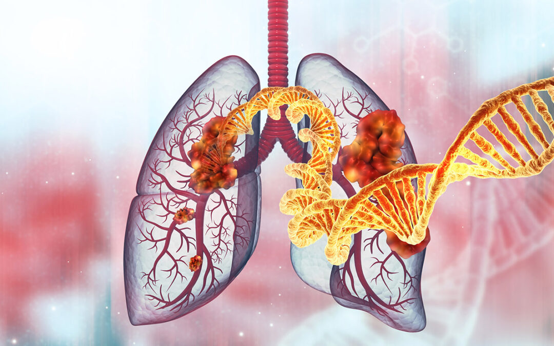 Targeted Therapy vs Chemo for Lung Cancer?