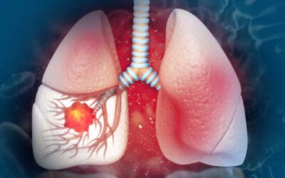 What Are the Early Signs of Lung Cancer?