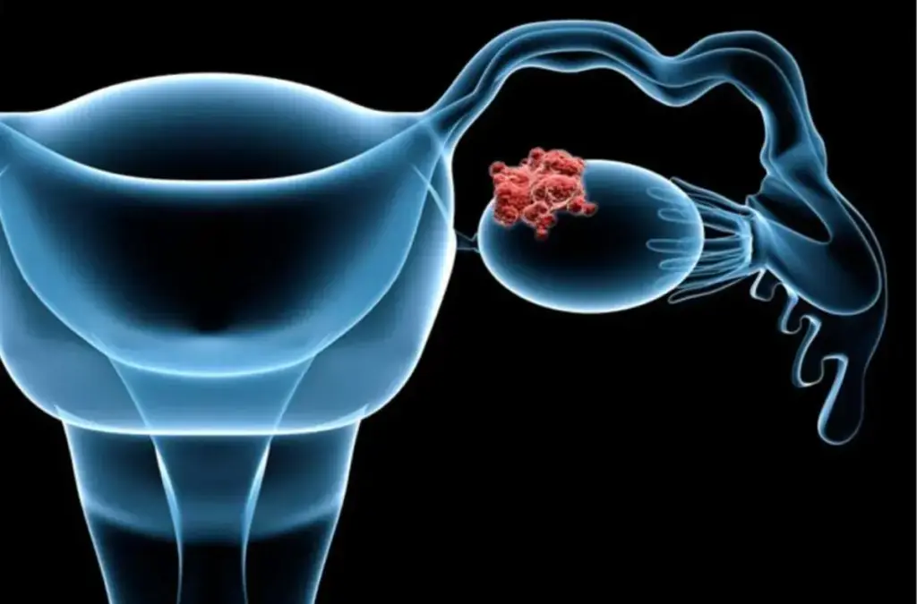Silent Signs of Ovarian Cancer - Dr. Sandeep Nayak