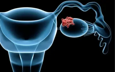 What Are the Silent Signs of Ovarian Cancer?