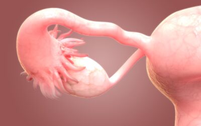 What Is Debulking Surgery for Ovarian Cancer?