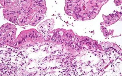 What Is a Frozen Section During Surgery?