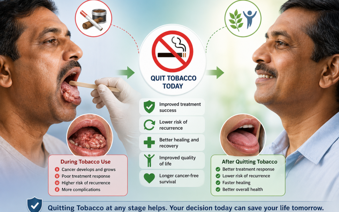 Does Quitting Tobacco Help After Oral Cancer