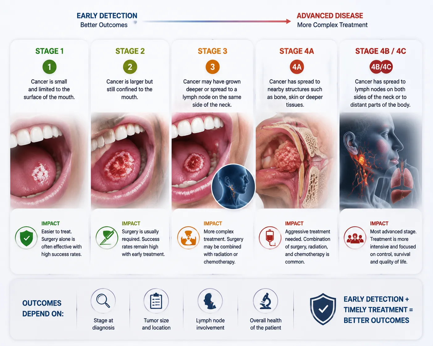 Oral cancer Infographic showing cancer stages 1–4 with progression from small surface lesion to advanced spread and treatment implications.