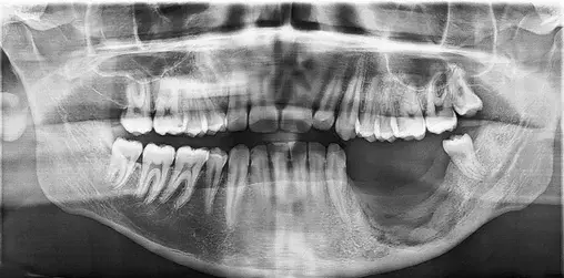 Oral cancer Panoramic dental X-ray showing both upper and lower jaws and teeth on a single image.