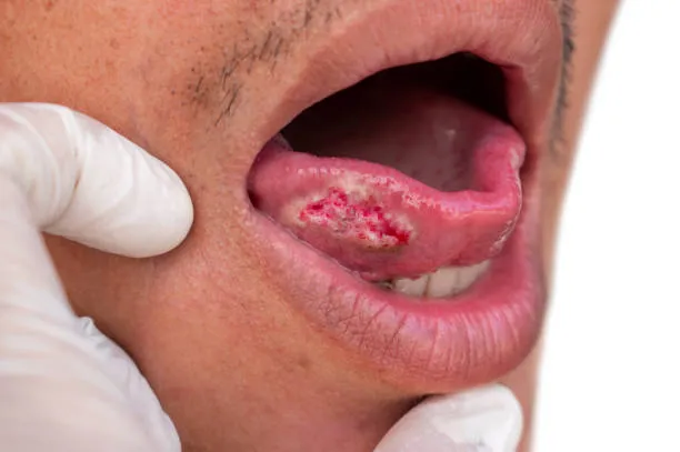 Oral cancer
