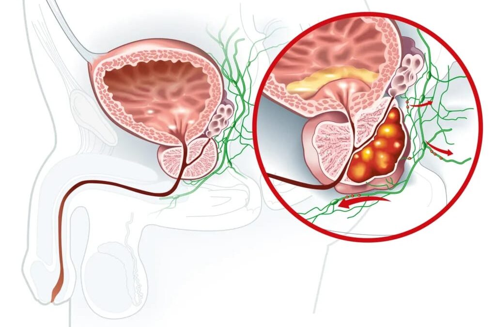 Robotic Prostatectomy for Prostate Cancer