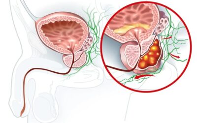 What Is Robotic Prostatectomy and How Is It Done?