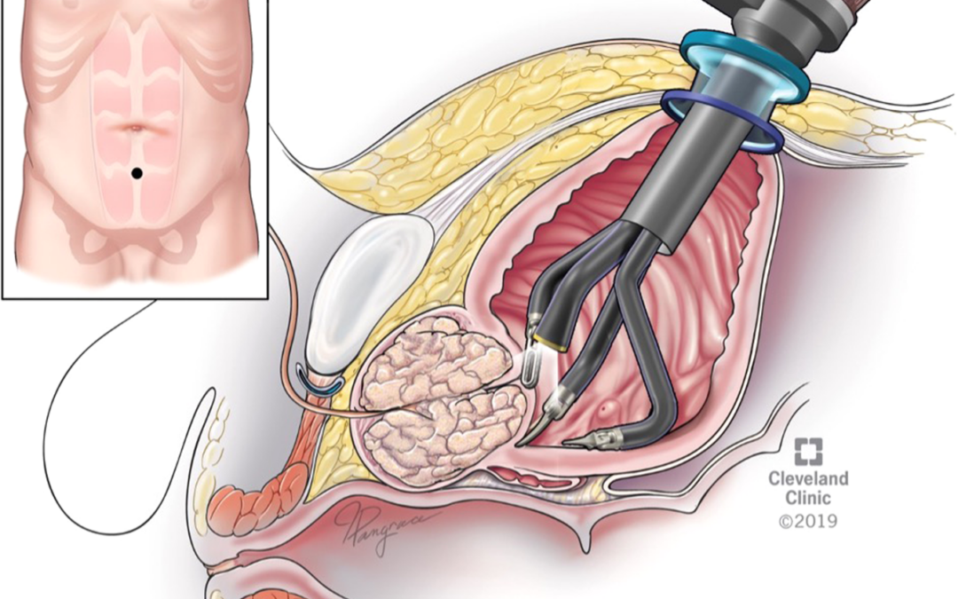 Robotic vs Open Prostatectomy Safety - Dr. Sandeep Nayak