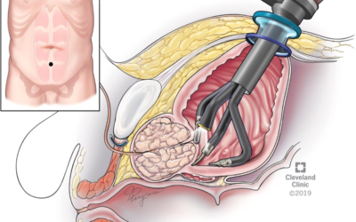 Robotic vs Open Prostatectomy: Which Is Safer?