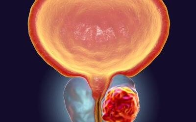 Surgery vs Radiation: Which for Prostate Cancer?