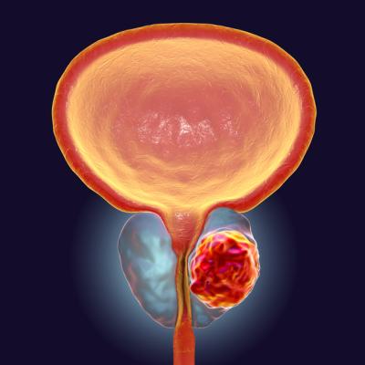 course of radiation therapy