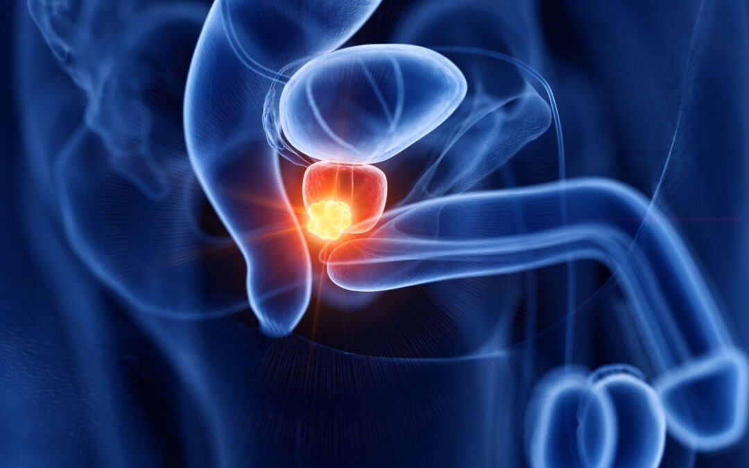 Curing Prostate Cancer Without Surgery - Dr. Sandeep Nayak