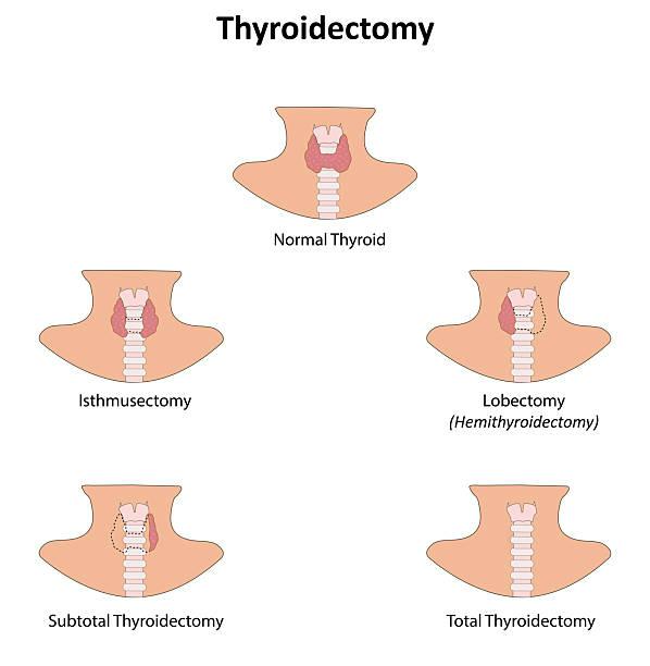 infographic showing thyroid anatomy and five surgical options: normal thyroid, isthmusectomy, lobectomy (hemithyroidectomy), subtotal thyroidectomy, and total thyroidectomy.